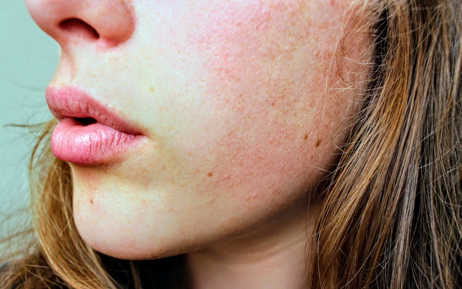 5 Reasons Why You Have Dry Skin After Moisturizing