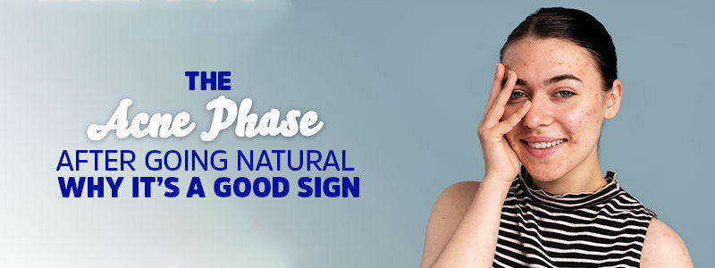 The Acne Phase After Going Natural | Why It’s a Good Sign